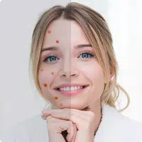 Remove Acne from Face APK